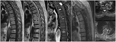 Case Report: A Review of the Literature on Spinal Intradural Hemangiopericytoma With Spinal Cord Infiltration and a Case Report
